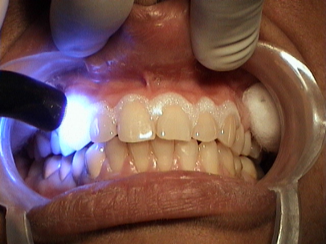 SolaIndia Laser Dentistry